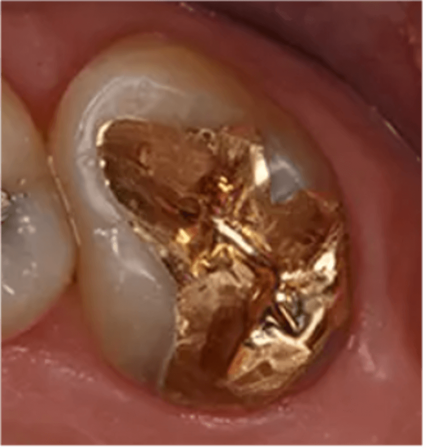 Understanding The Value of Dental Gold & How to Sell It